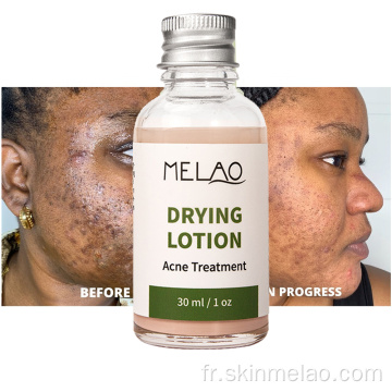 Séchage de la lotion anti-acné sérum de traitement au point